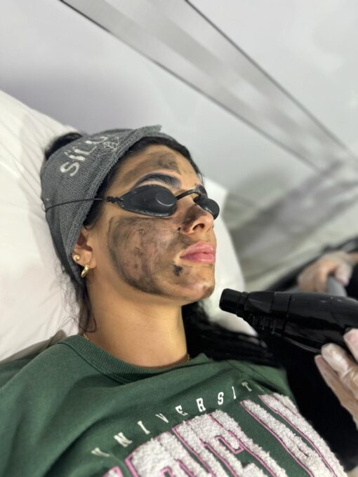 LIMPIEZA FACIAL CON LASER HOLLYWOOD PEEL
